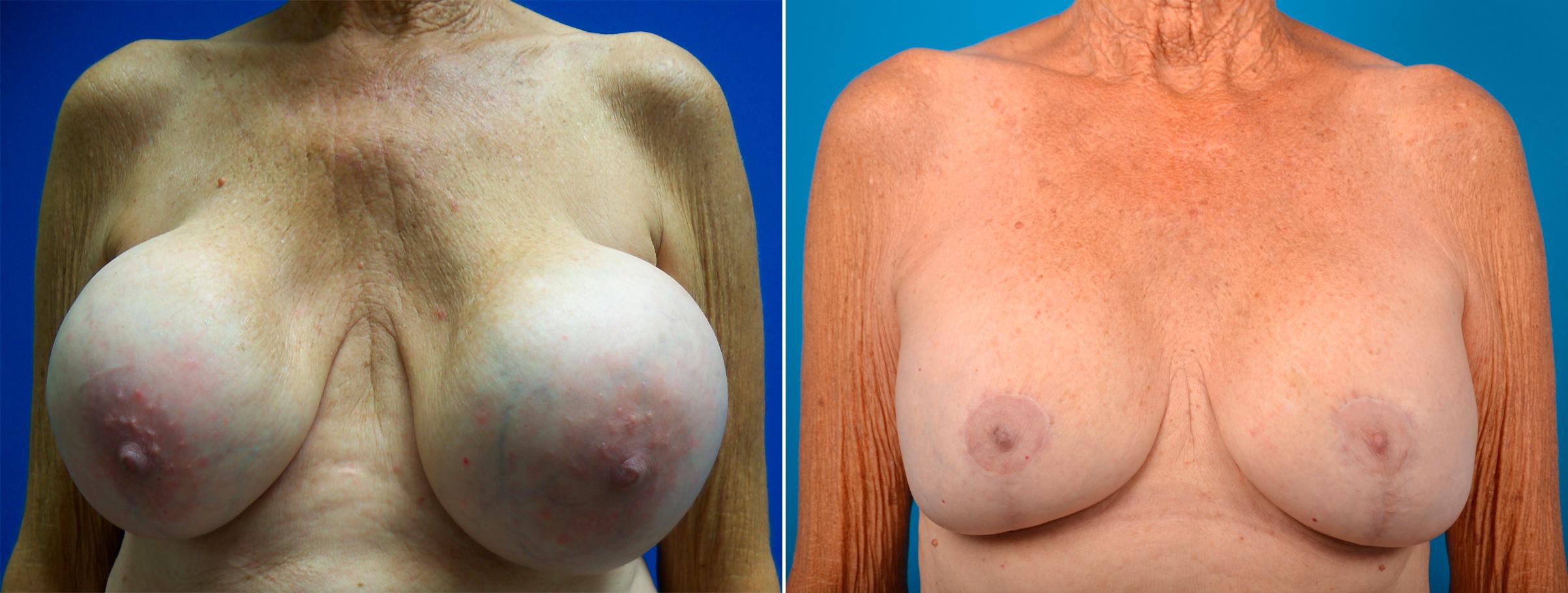 Hidden Breast Implant Exchange Before & After Gallery - Patient 149739 - Image 1