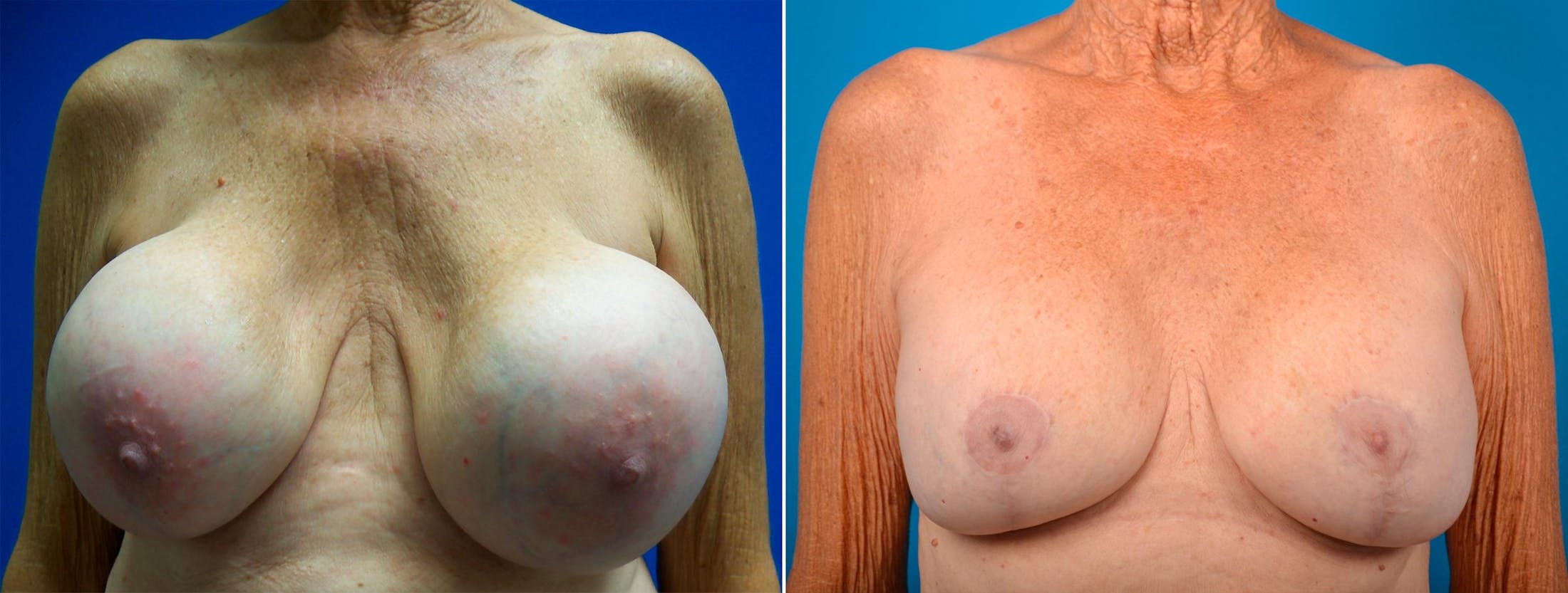 Breast Implant Exchange Before & After Gallery - Patient 122405418 - Image 1