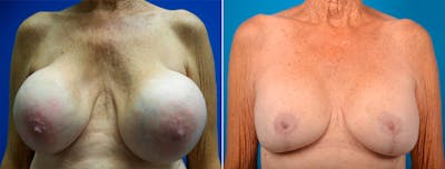 Breast Implant Exchange Before & After Gallery - Patient 128413 - Image 1