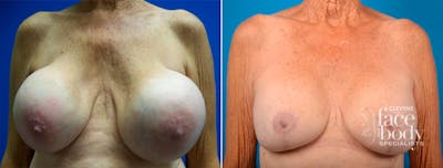 Hidden Breast Implant Exchange Before & After Gallery - Patient 149739 - Image 1