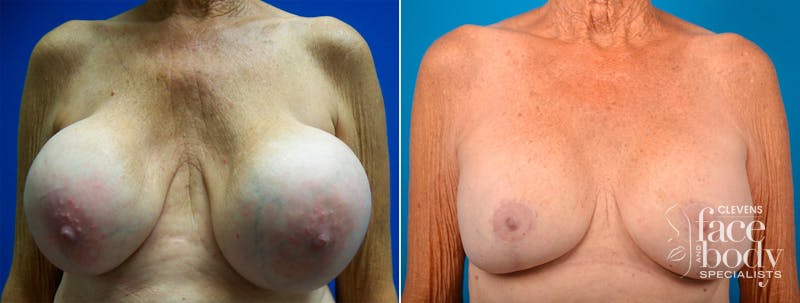 Hidden Breast Implant Exchange Before & After Gallery - Patient 122405418 - Image 1