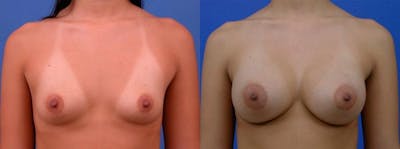 Breast Augmentation Before & After Gallery - Patient 122405417 - Image 1