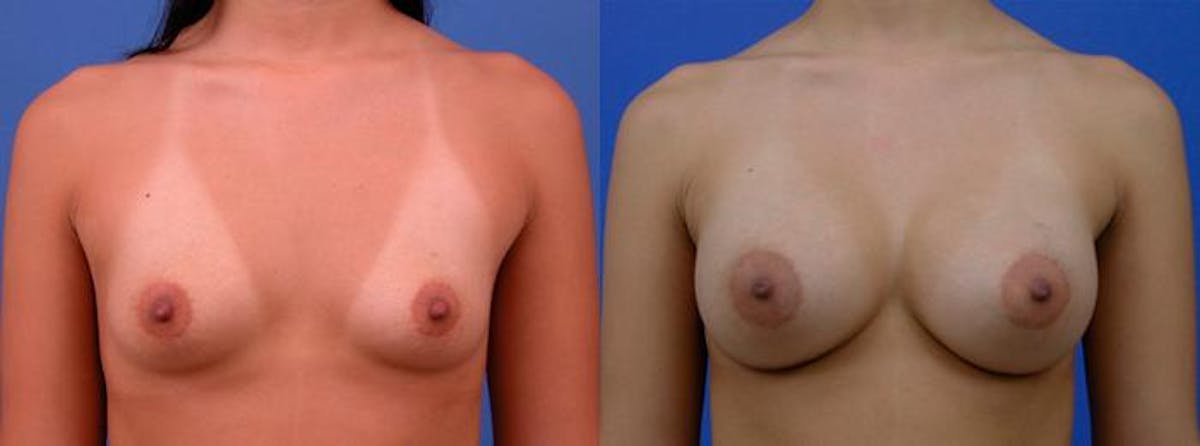 Breast Augmentation Before & After Gallery - Patient 122405417 - Image 1