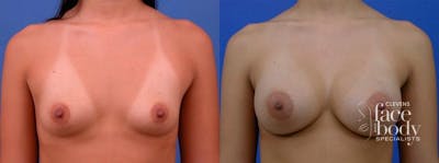 Hidden Breast Aug Before & After Gallery - Patient 356729 - Image 1