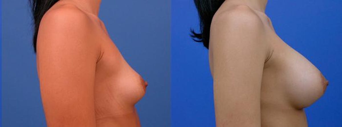 Breast Augmentation Before & After Gallery - Patient 779990 - Image 2