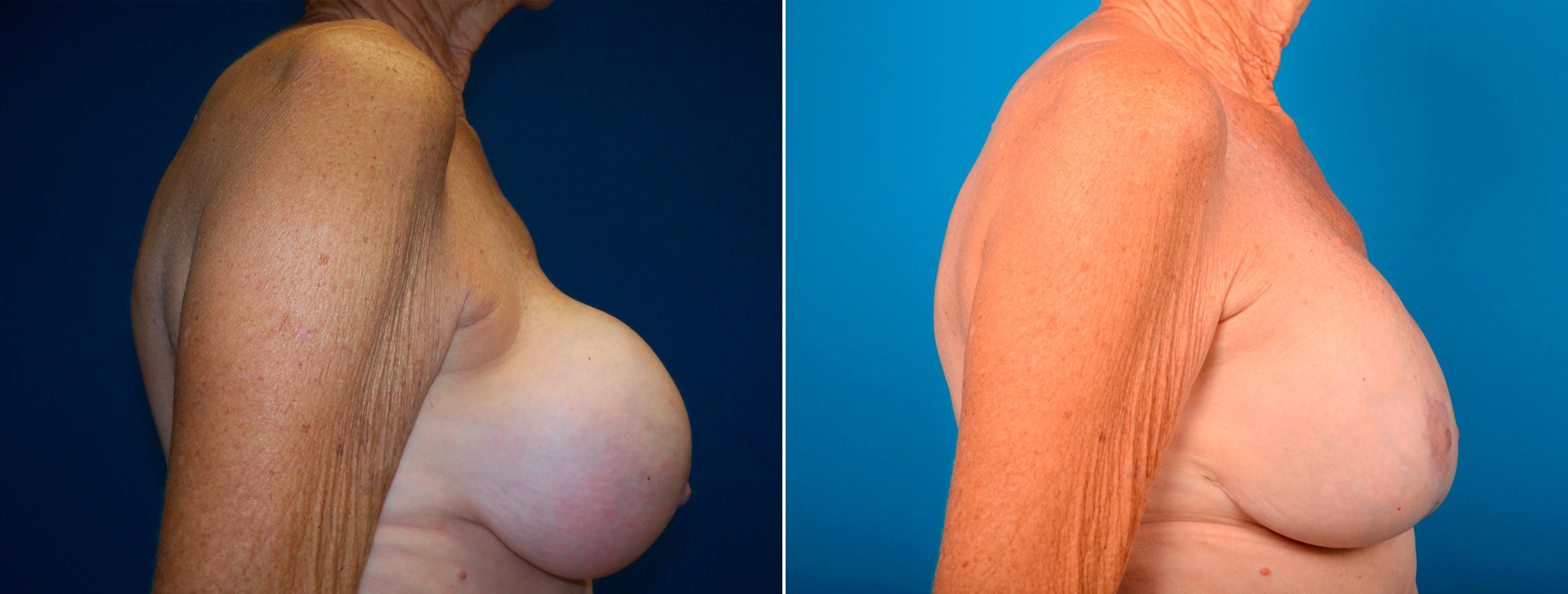 Hidden Breast Implant Exchange Before & After Gallery - Patient 149739 - Image 2