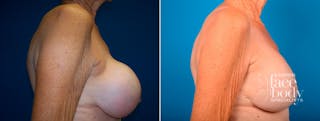 Hidden Breast Implant Exchange Before & After Gallery - Patient 122405418 - Image 2