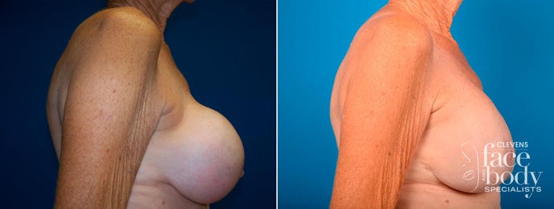 Hidden Breast Implant Exchange Before & After Gallery - Patient 122405418 - Image 2