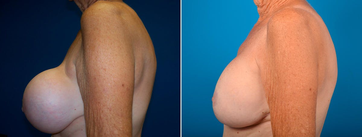 Breast Implant Exchange Before & After Gallery - Patient 128413 - Image 3