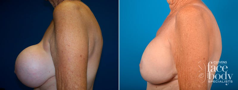 Hidden Breast Implant Exchange Before & After Gallery - Patient 122405418 - Image 3