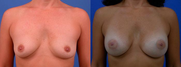Hidden Breast Aug Before & After Gallery - Patient 304346 - Image 1