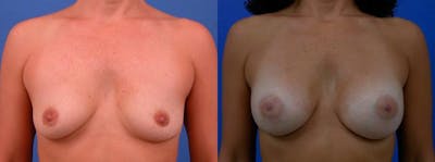 Breast Augmentation Before & After Gallery - Patient 122405419 - Image 1