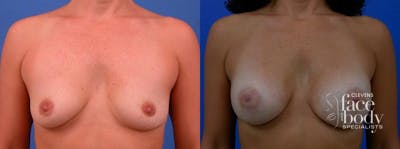 Hidden Breast Aug Before & After Gallery - Patient 310343 - Image 1
