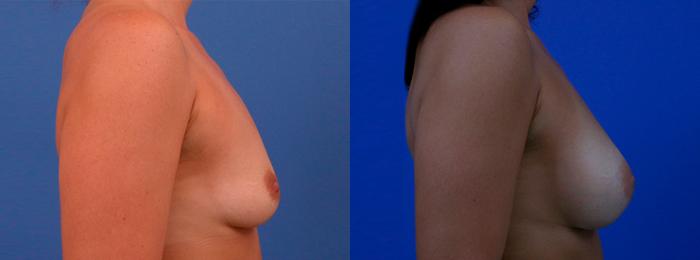 Hidden Breast Aug Before & After Gallery - Patient 304346 - Image 2