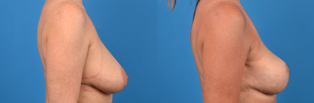 Breast Implant Removal Before & After Gallery - Patient 122405420 - Image 2