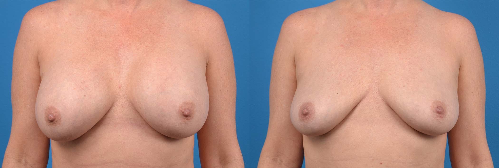 Breast Implant Removal Before & After Gallery - Patient 122405423 - Image 1