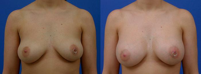 Hidden Breast Aug Before & After Gallery - Patient 424830 - Image 1