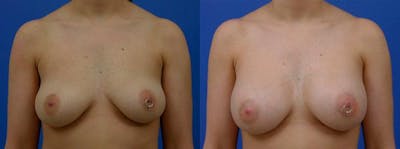 Breast Augmentation Before & After Gallery - Patient 122405422 - Image 1