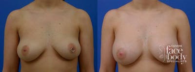 Hidden Breast Aug Before & After Gallery - Patient 424830 - Image 1