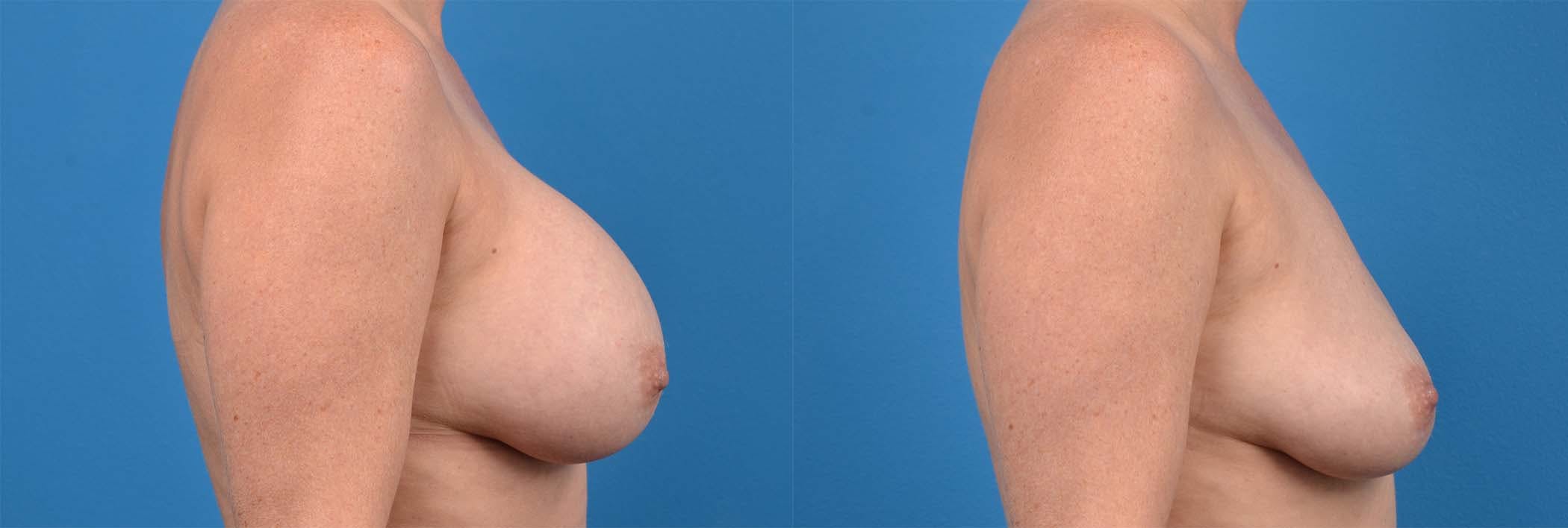 Breast Implant Removal Before & After Gallery - Patient 122405423 - Image 2