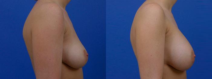 Hidden Breast Aug Before & After Gallery - Patient 424830 - Image 2