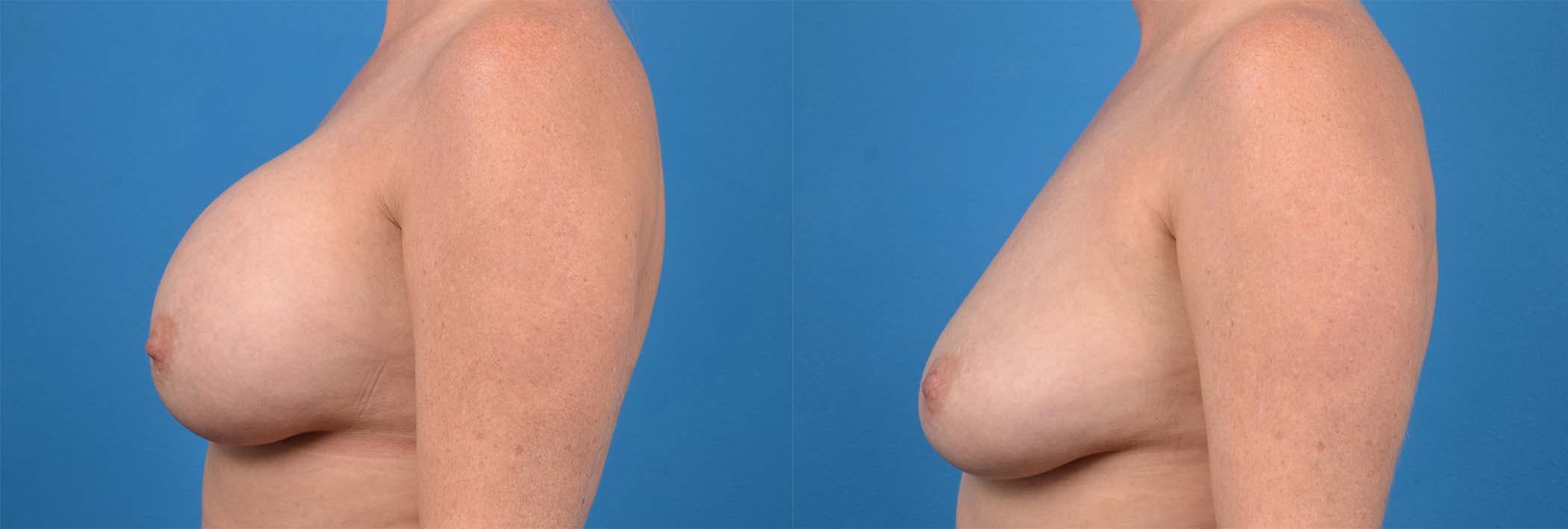 Breast Implant Removal Before & After Gallery - Patient 122405423 - Image 3