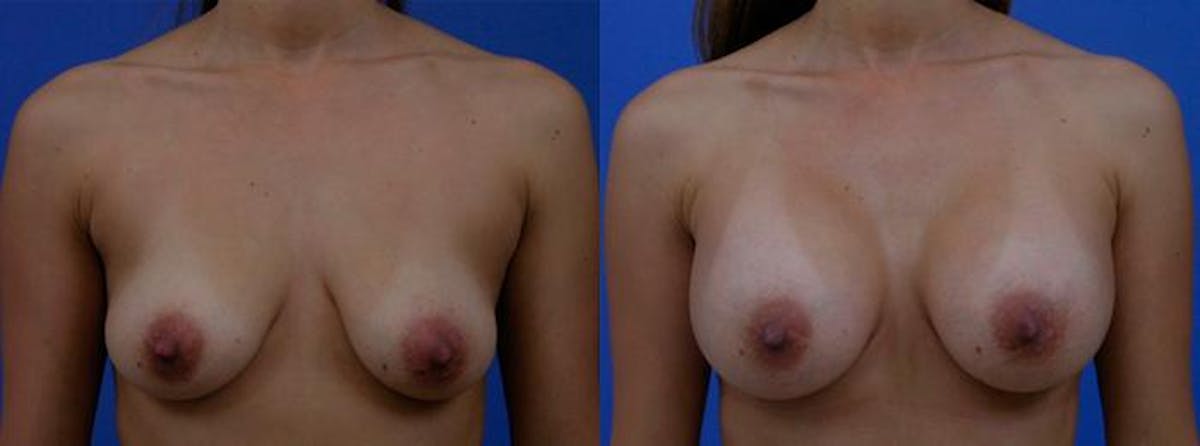 Breast Augmentation Before & After Gallery - Patient 671575 - Image 1