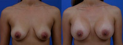 Breast Augmentation Before & After Gallery - Patient 122405424 - Image 1