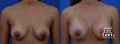 Hidden Breast Aug Before & After Gallery - Patient 159500 - Image 1