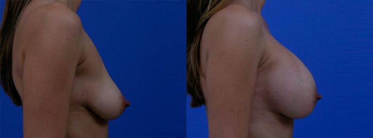 Breast Augmentation Before & After Gallery - Patient 671575 - Image 2
