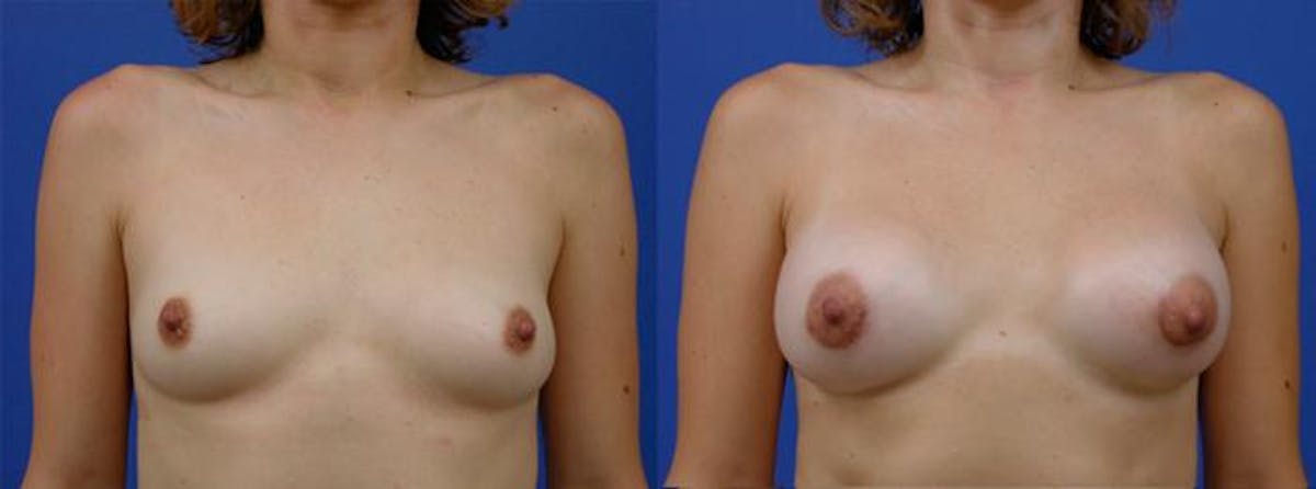 Breast Augmentation Before & After Gallery - Patient 198118 - Image 1