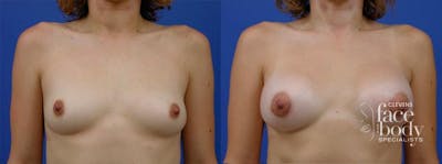 Hidden Breast Aug Before & After Gallery - Patient 265330 - Image 1