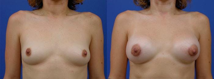 Breast Augmentation Before & After Gallery - Patient 122405425 - Image 1