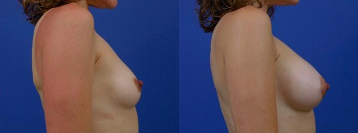 Breast Augmentation Before & After Gallery - Patient 122405425 - Image 2