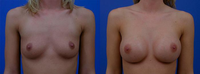 Hidden Breast Aug Before & After Gallery - Patient 309206 - Image 1