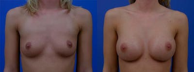 Breast Augmentation Before & After Gallery - Patient 134304 - Image 1