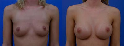 Breast Augmentation Before & After Gallery - Patient 122405426 - Image 1