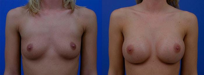 Breast Augmentation Before & After Gallery - Patient 122405426 - Image 1