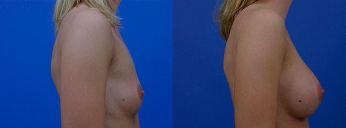 Breast Augmentation Before & After Gallery - Patient 122405426 - Image 2