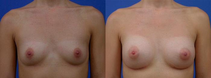 Hidden Breast Aug Before & After Gallery - Patient 313298 - Image 1
