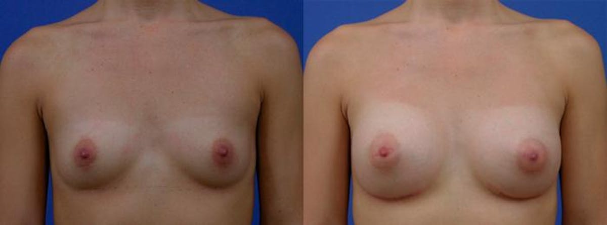 Breast Augmentation Before & After Gallery - Patient 322684 - Image 1