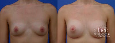 Hidden Breast Aug Before & After Gallery - Patient 313298 - Image 1