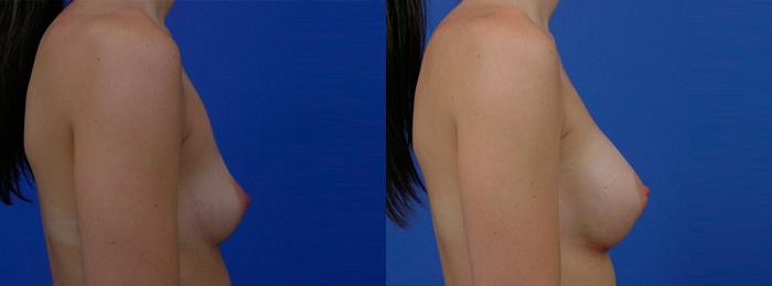 Hidden Breast Aug Before & After Gallery - Patient 313298 - Image 2