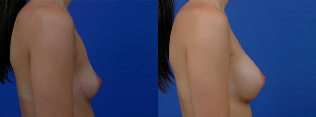 Breast Augmentation Before & After Gallery - Patient 322684 - Image 2