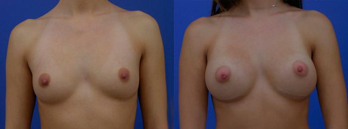 Hidden Breast Aug Before & After Gallery - Patient 986149 - Image 1