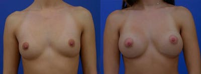 Breast Augmentation Before & After Gallery - Patient 366338 - Image 1