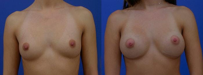 Breast Augmentation Before & After Gallery - Patient 122405428 - Image 1