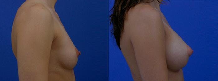 Breast Augmentation Before & After Gallery - Patient 122405428 - Image 2