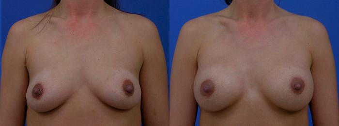 Hidden Breast Aug Before & After Gallery - Patient 421983 - Image 1