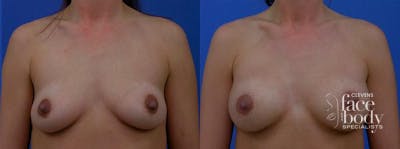 Hidden Breast Aug Before & After Gallery - Patient 421983 - Image 1